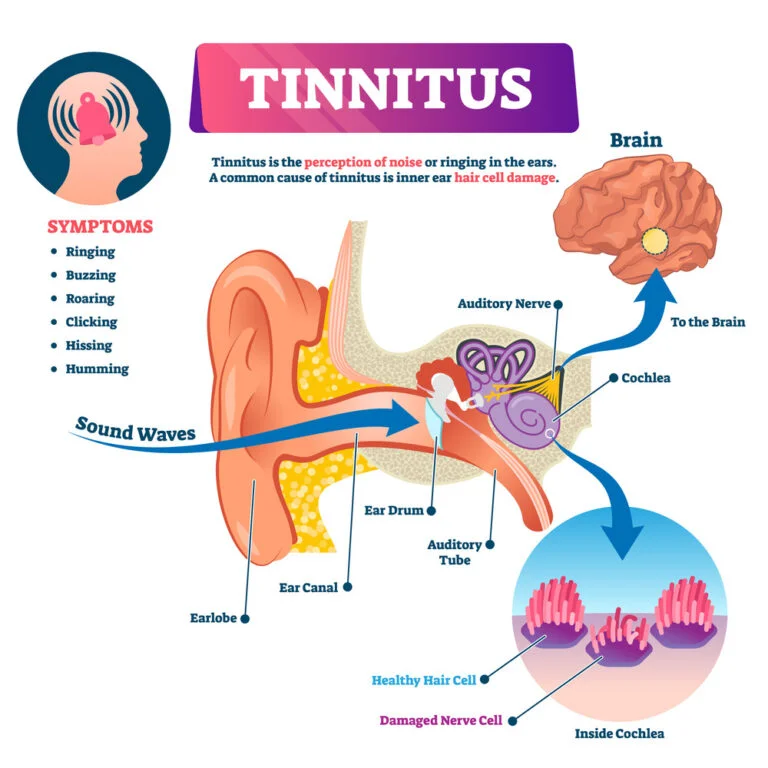 Informational tinnitus graphic, helps to debunk tinnitus myth.